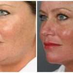 Лазерная процедура для лица: особенности процедуры, эффективность, фото