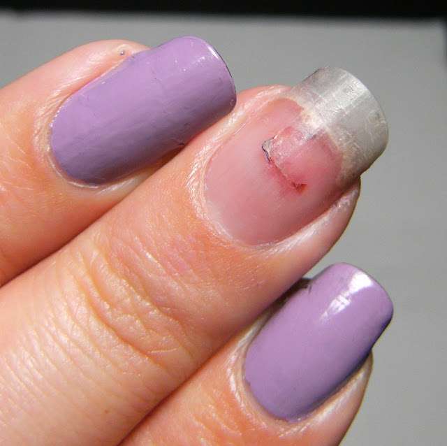 Травма ногтевого ложа