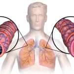 Приступ бронхиальной астмы: неотложная помощь, алгоритм действий и рекомендации врачей