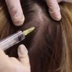 Мезотерапия для волос: виды средств, описание, отзывы