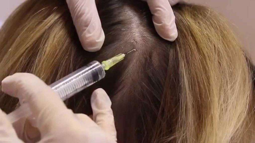 мезогенезис для волос